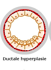Ductale hyperplasie