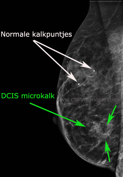 Kalkspatten_mammogram_DCIS