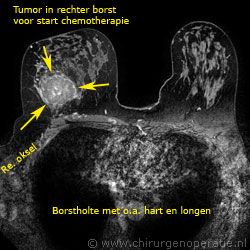 MRI mammogram