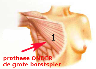 borstspier_borstprothese