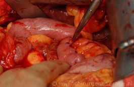 anastomose pancreas 3