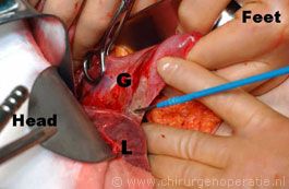 dissect gallbladder
