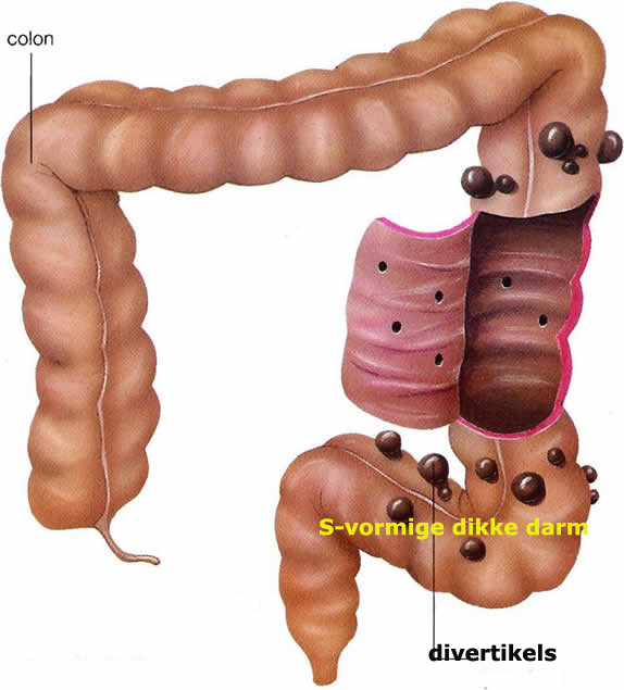 diverticulosis_colon_sigmoid2