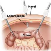 laparoscopische_chirurgie_colon
