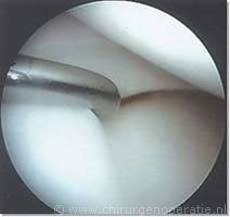 normale_meniscus