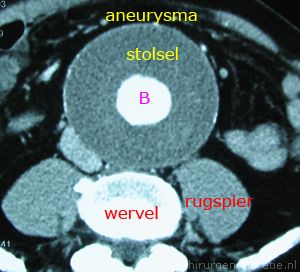 CT_scan_aneurysma